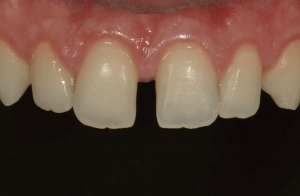 Antes das lentes de contato