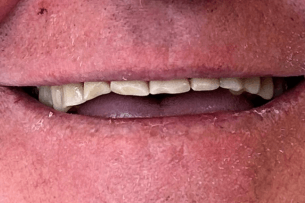 Antes do implante dentário