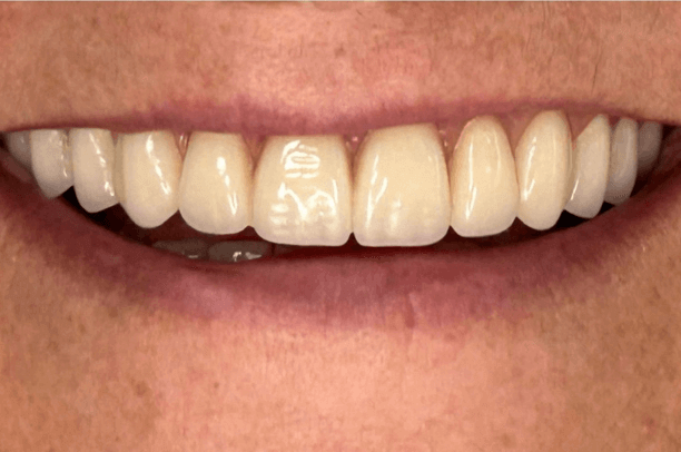 Depois do clareamento dental