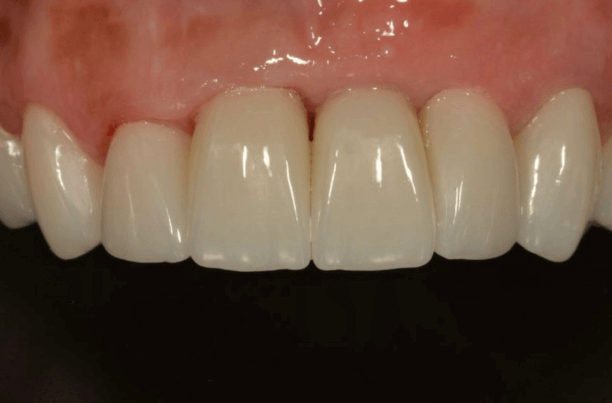 Depois da ortodontia